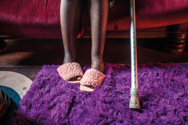Patience Kanyangarara, 14, born with severe bilateral clubfoot, only started receiving clinical treatment at the age of nine, by which time her clubfoot had become difficult to address. After numerous surgeries and many months in plaster casts and braces, her feet have largely straightened out