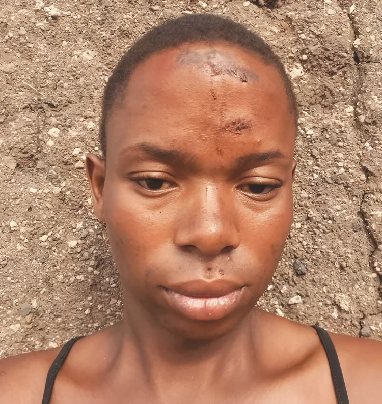 Portrait of a transgender woman with a healing wound on her forehead